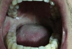 吃伽师瓜口腔刺痛,揭秘美味背后的隐患